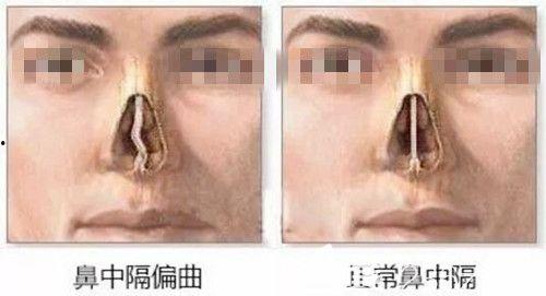 鼻中隔弯曲手术视频,鼻中隔弯曲矫正手术全过程解析